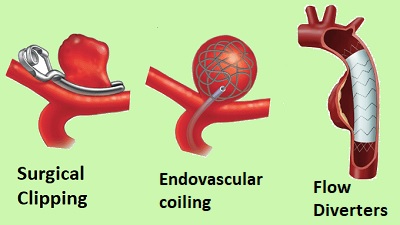 Côte d’Ivoire /Comprendre l’Anévrisme : Opération et réussite en 2023