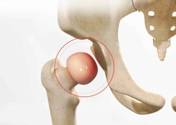 Côte d’Ivoire/Lumière sur l&rsquo;Ostéo Nécrose de la tête fémorale : Tout ce que vous devez savoir sur l’opération de la hanche