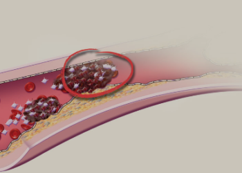 Côte d’Ivoire/ Découvrez les Maladies vasculaires périphériques : Symptômes, causes et traitements
