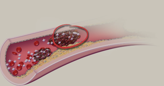 Côte d’Ivoire/ Découvrez les Maladies vasculaires périphériques : Symptômes, causes et traitements