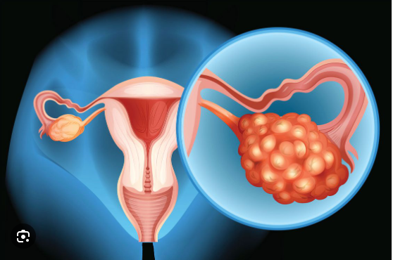 Côte d’Ivoire/Le cancer de l’ovaire : une menace silencieuse