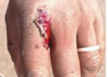 DU TAC AU TAC : Seul aux départementales : le RHDP fait couler son propre sang !