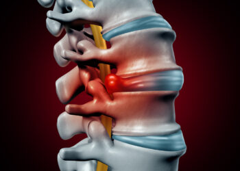 Réussir l&rsquo;opération de l&rsquo;hernie discale : conseils et perspectives en 2023