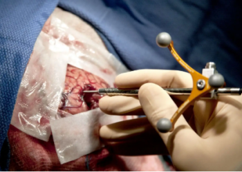 Chirurgie du Cerveau/ Retirer une tumeur cérébrale : Procédure, complexités et précautions