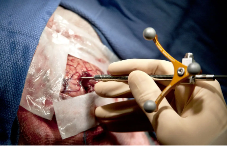 Chirurgie du Cerveau/ Retirer une tumeur cérébrale : Procédure, complexités et précautions