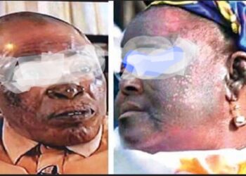 Teint clair forcé : les graves dangers des produits éclaircissants pour la santé