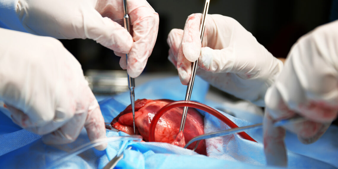 Percer le mystère cardiaque : Décortiquer l&rsquo;opération de l&rsquo;infarctus du myocarde