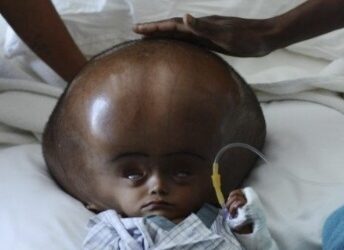 Chirurgie du Cerveau : l&rsquo;Hydrocéphalie sous les projecteurs : Etapes vitales, réussite et sensibilisation