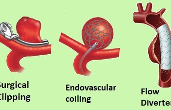 Côte d&rsquo;Ivoire /Comprendre l&rsquo;Anévrisme : Opération et réussite en 2023
