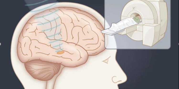 Côte d’Ivoire/Comprendre l&rsquo;Opération de la Maladie de Parkinson et Tremblements Essentiels