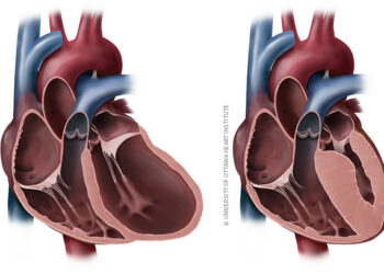 Prévenir la Cardiomyopathie reste essentiel