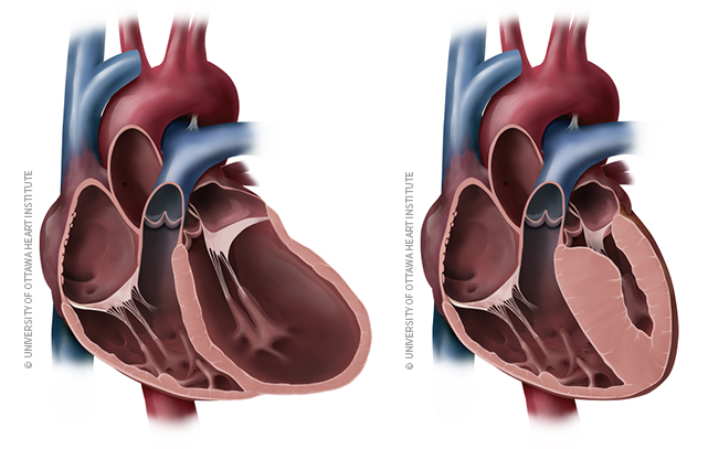 Prévenir la Cardiomyopathie reste essentiel