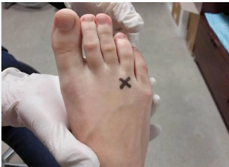 Côte d&rsquo;Ivoire/Guide complet sur l&rsquo;opération chirurgicale du Névrome de Morton